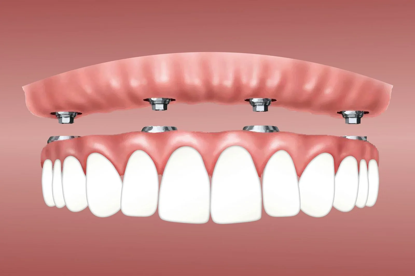 All-on-4 : arcade complète de dents fixes vissée sur 4 implants