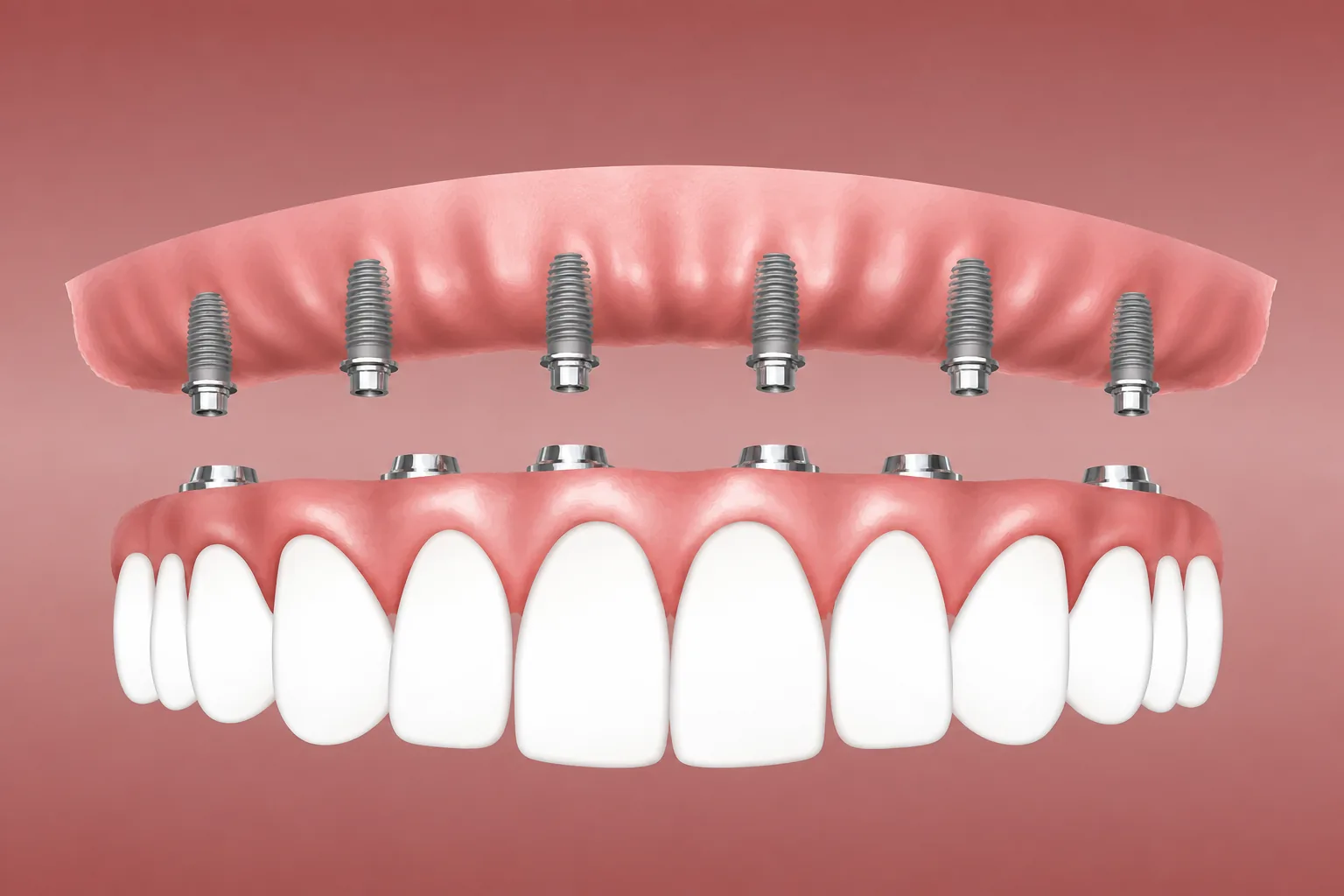 All-on-6 : arcade complète de dents fixes vissée sur 6 implants