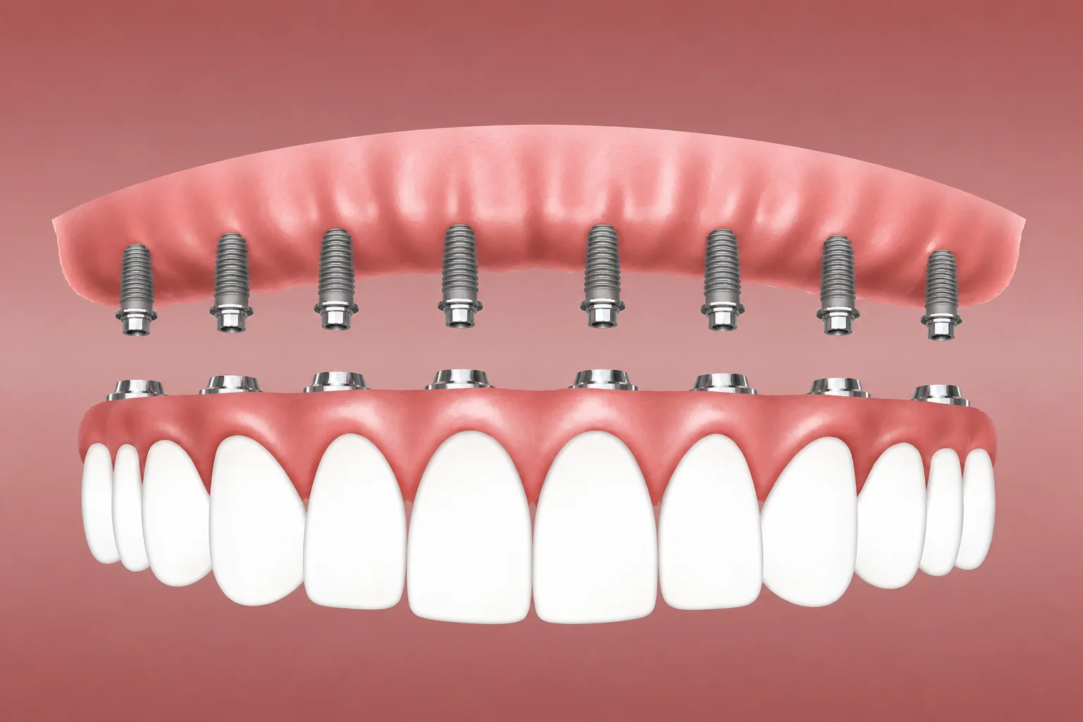 Bridge céramique complet posé sur 8 implants, solution premium