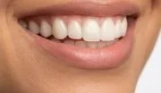 Couronne tout céramique, translucide comme une dent naturelle