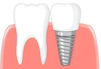 Implant unitaire en titane surmonté d'une couronne céramique