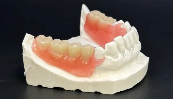 Prothèse partielle souple Valplast, sans crochet métallique