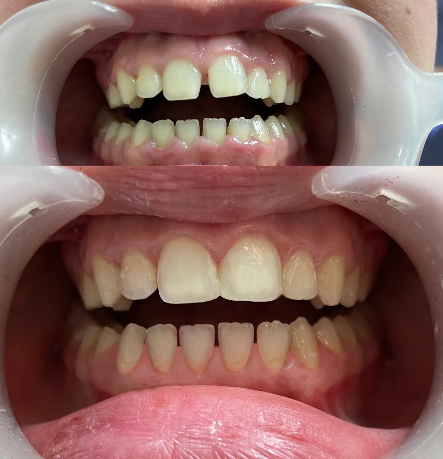 Avant-après : gingivectomie et fermeture d'espace