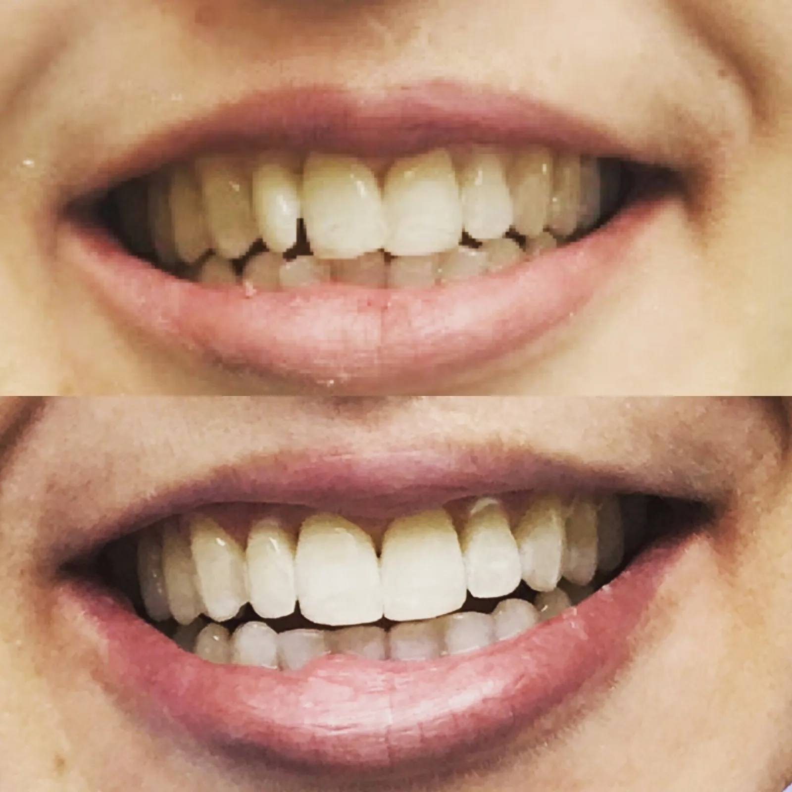 Avant-après : Invisalign et blanchiment