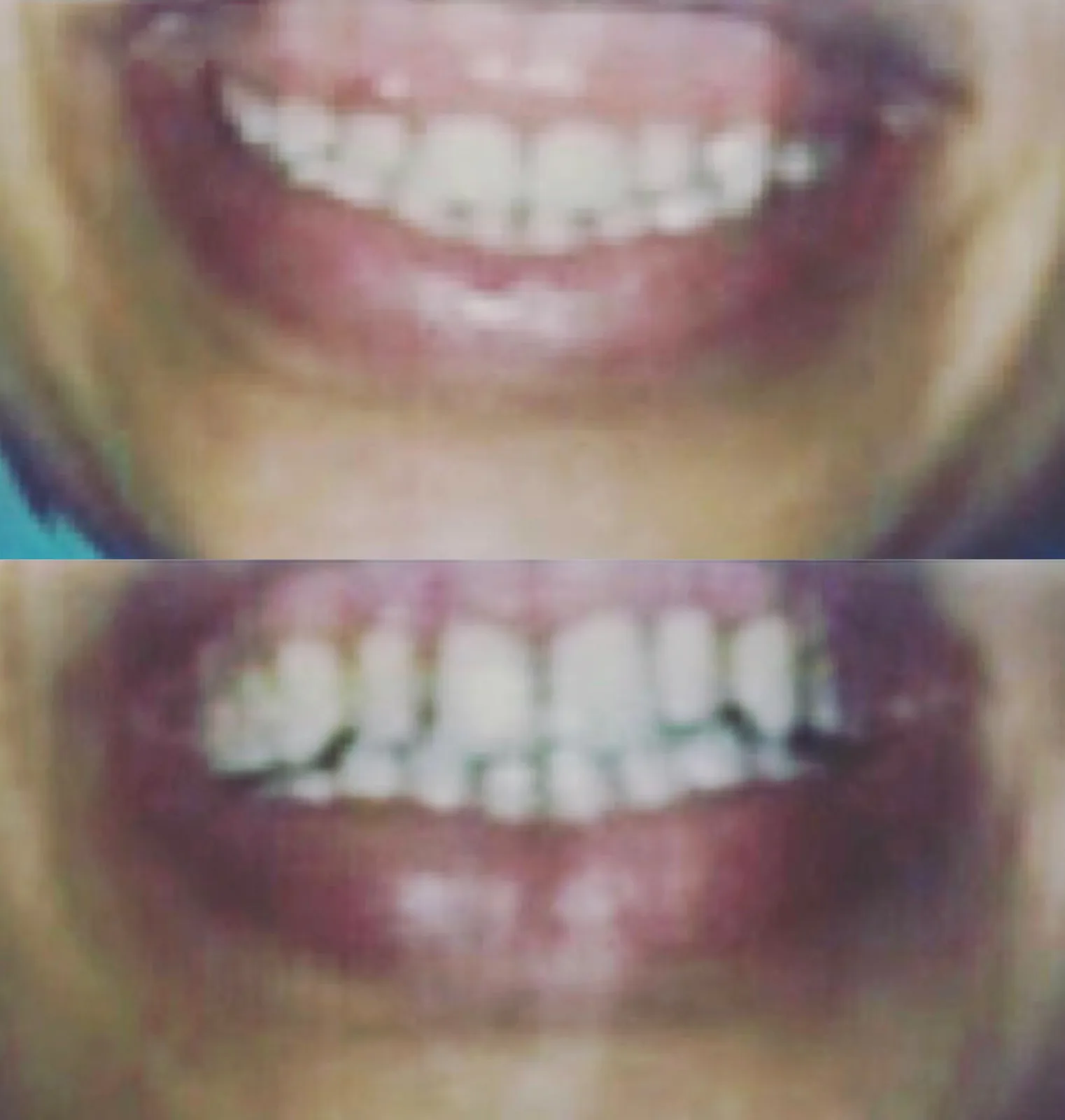 Avant-après : gingivectomie