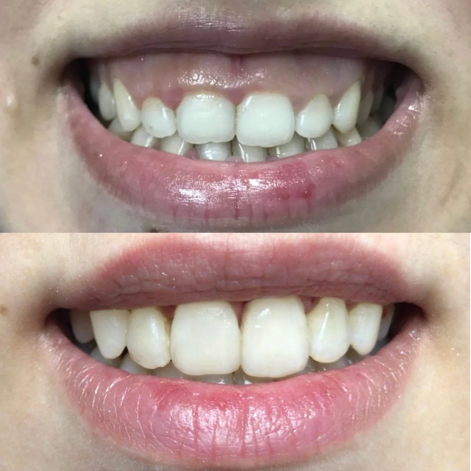 Avant-après : gingivectomie