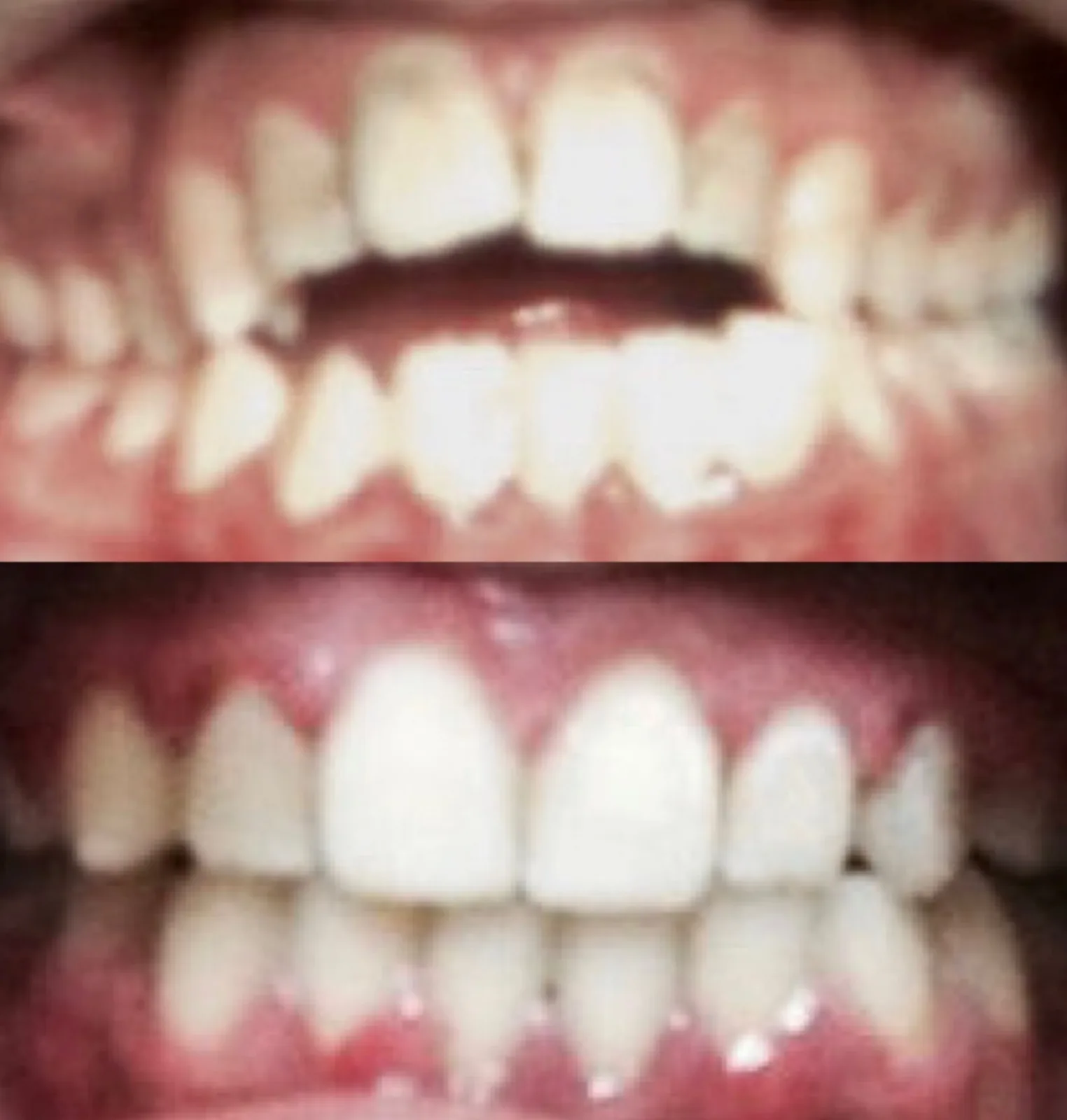 Avant-après : orthodontie pour résoudre une béance