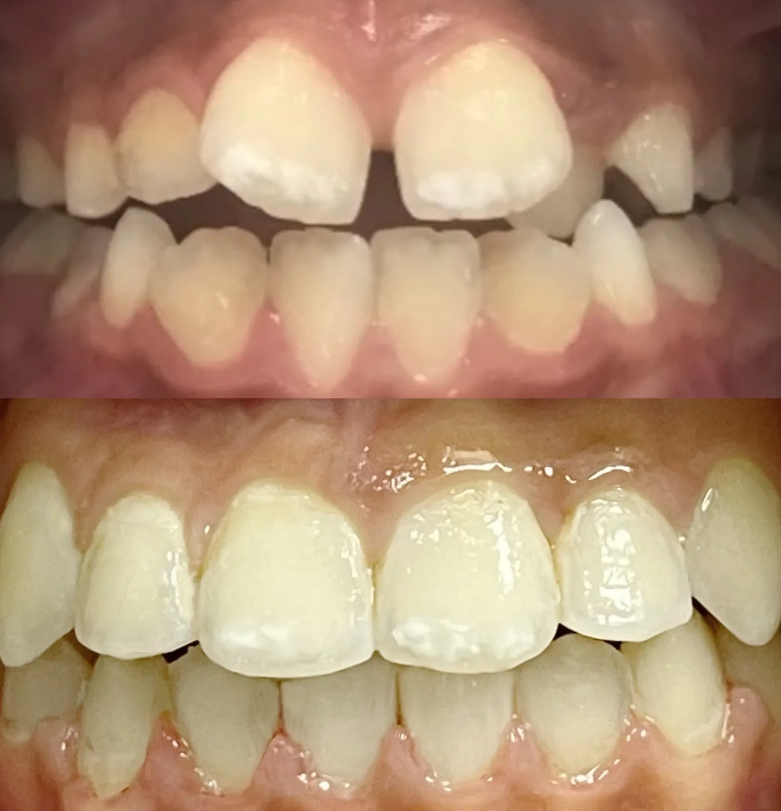 Avant-après : traction chirurgicale d'une canine et bagues